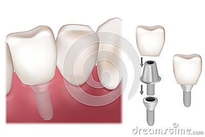 Dental Implant Recovery. Premolar tooth crown installation over implant abutment. Premolar tooth recovery with implant Vector Illustration