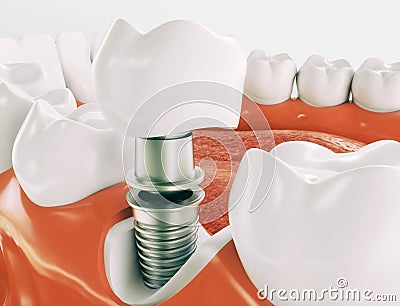 Dental implant - Series 2 of 3 - 3d rendering Stock Photo