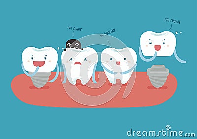 Dental implant Vector Illustration