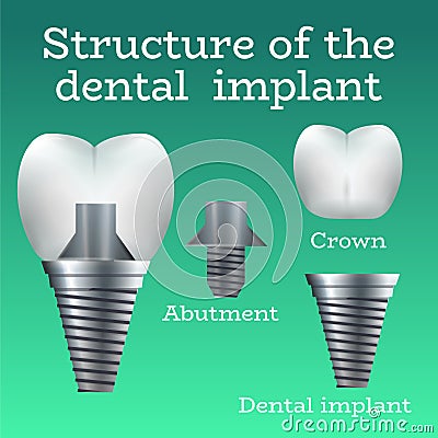 Dental implant structure Vector Illustration