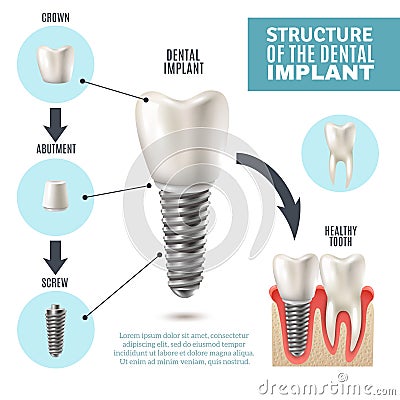 Dental Implant Structure Medical Infographic Poster Vector Illustration