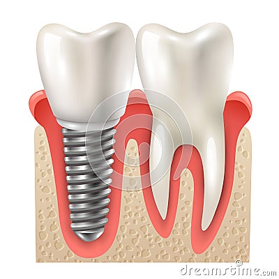 Dental Implant Tooth Set Closeup Model Vector Illustration