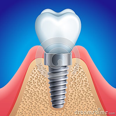 Dental implant Vector Illustration