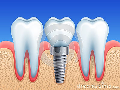 Dental implant Vector Illustration