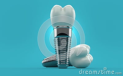 Dental implants Cartoon Illustration