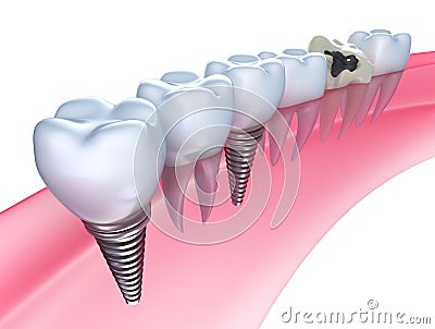 Dental implants in the gum Stock Photo