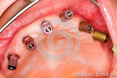 Dental implants with impression posts Stock Photo