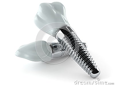 Dental implants Stock Photo