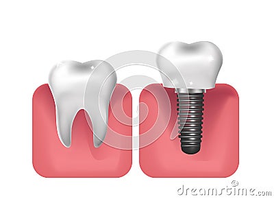 Dental implants, prosthetics 3D realistic style. Dentistry, healthy teeth concept. Vector illustration Vector Illustration