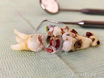 Dental instruments and extracted teeth on a napkin Stock Photo