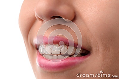 Dental medical care. Invisible braces Stock Photo