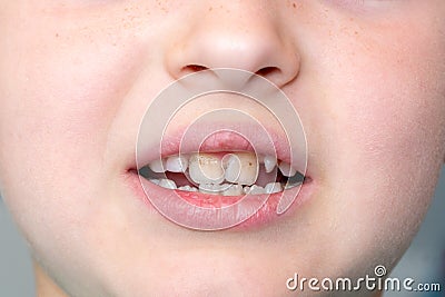 Dental medicine and healthcare. Little boy patient open mouth showing caries teeth decay Stock Photo