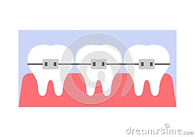 Dental metal braces for straightening teeth, diagram structure of gum Vector Illustration