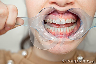 Dental mouth spreader, before teeth whitening Stock Photo