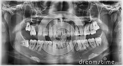 Dental panaromic x-ray film Stock Photo