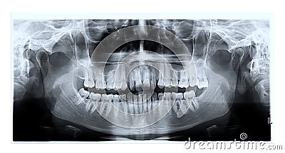 Dental panoramic x-ray film Stock Photo