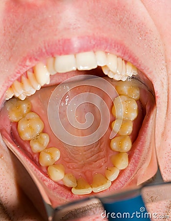 Dental photography Stock Photo
