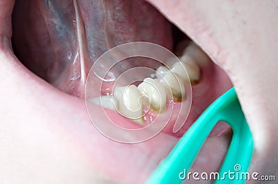 Dental plaque on teeth, caries, gingivitis, periodontitis, periodontal disease, tartar, professional oral hygiene, gingivitis Stock Photo