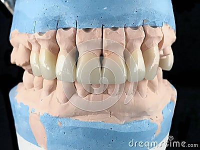 Dental porcelain prosthesis implant tooth in dental laboratory. Front view. Selective focus. Lower and upper jaw in Stock Photo