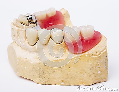 Dental prosthesis Stock Photo