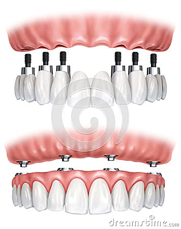 Dental prosthesis Stock Photo