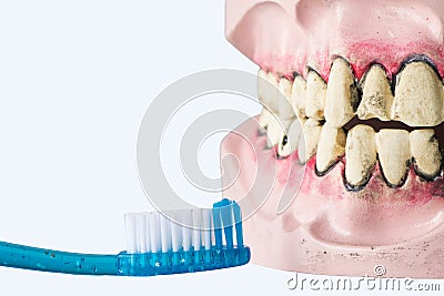 Dental prosthesis with bad teeth, infected gums and tooth brush. dentures showing cavities. Dental Health for prevention Stock Photo