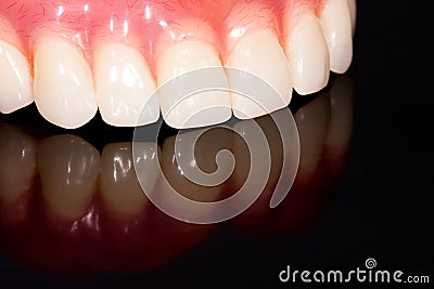 Dental prosthesis Stock Photo