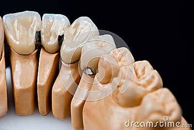 Dental prosthesis model with implanted teeth Stock Photo