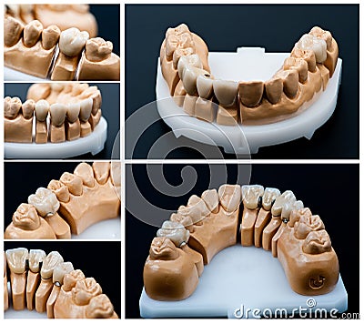 Dental prosthesis models collage Stock Photo