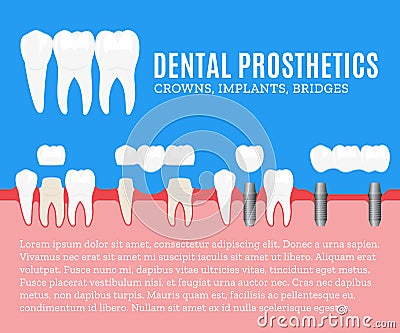 Dental prosthetics illustration Vector Illustration