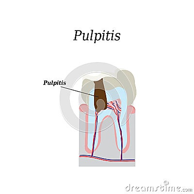 Dental pulp. Vector illustration on Vector Illustration