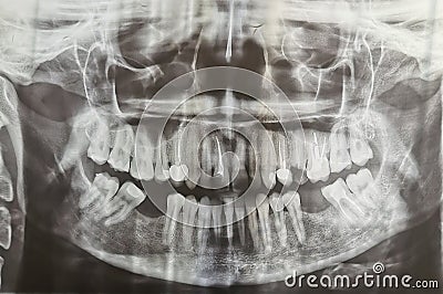 Dental radiography. Digital x-ray teeth scan of adult female. Stock Photo