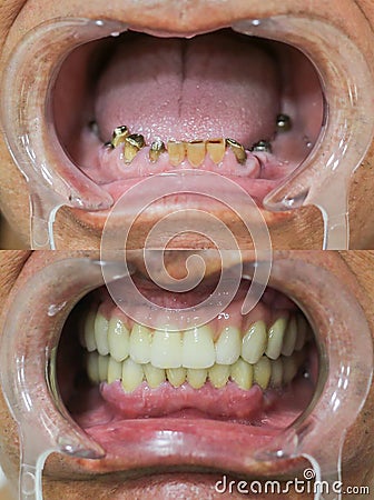 Dental repair - full dental bridge on dental implants Stock Photo