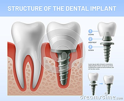 Dental teeth implant. Implantation procedure or tooth crown abutments. Health care vector illustration Cartoon Illustration