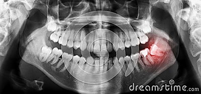 Dental teeth x-ray panoramic scan with skewed wisdom tooth Stock Photo