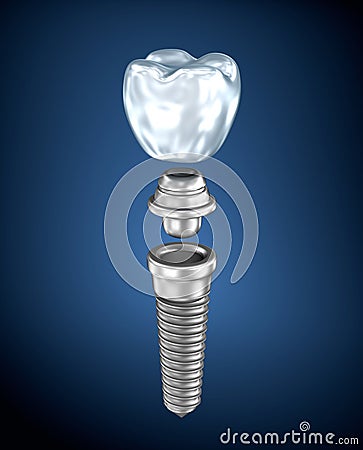 Dental titanium implant Stock Photo