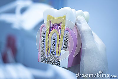 Dental tooth model cast showing decay enamel roots Stock Photo