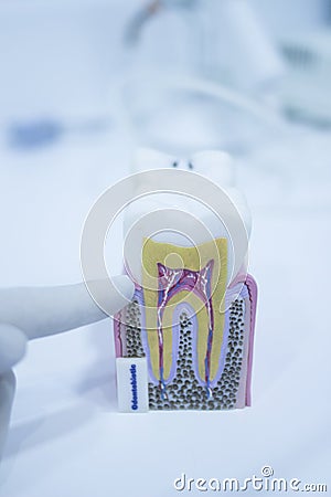 Dental tooth model cast showing decay enamel roots Stock Photo