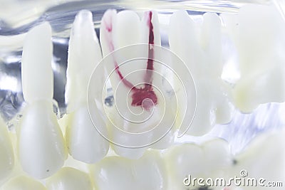 Dental tooth root canal Stock Photo