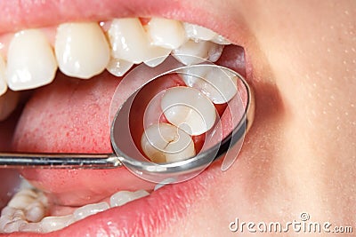 Dental treatment in dental clinic. Rotten carious tooth macro. T Stock Photo