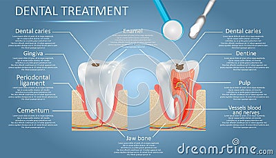 Dental treatment vector diagram education medical anatomy poster infographics Vector Illustration