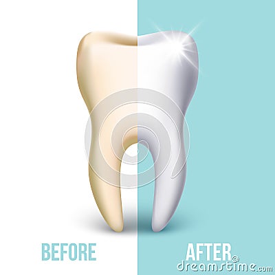 Dental veneer, teeth whitening vector concept Vector Illustration