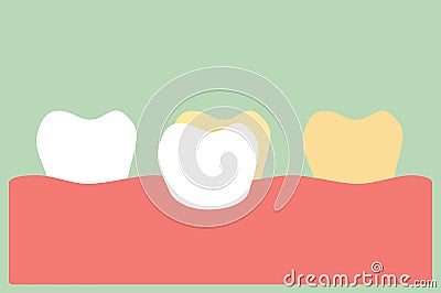 Dental veneers installation procedure for tooth whiten Vector Illustration