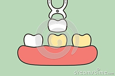 Dental veneers installation procedure for tooth whiten Vector Illustration