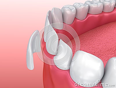 Dental Veneers: Porcelain Veneer installation Procedure Cartoon Illustration