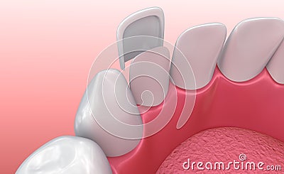 Dental Veneers: Porcelain Veneer installation Procedure Cartoon Illustration