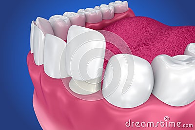 Dental Veneers: Porcelain Veneer installation Procedure. Cartoon Illustration