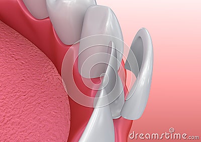 Dental Veneers: Porcelain Veneer installation Procedure Cartoon Illustration