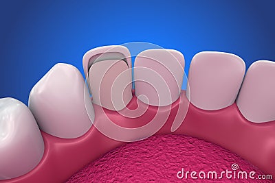 Dental Veneers: Porcelain Veneer installation Procedure. Cartoon Illustration