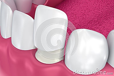 Dental Veneers: Porcelain Veneer installation Procedure Cartoon Illustration